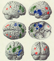 レビー小体型認知症 精神症状発症のメカニズム解明へ