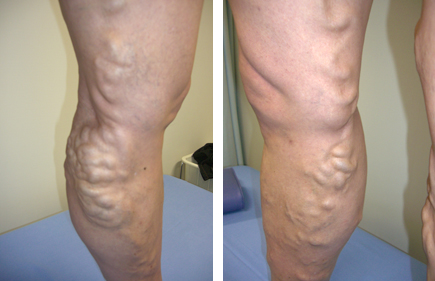 下肢静脈瘤手術　最新医療機器を導入